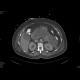 Acute necrosing pancreatitis: CT - Computed tomography